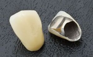 相模原市中央区横山エリア・のりデンタルクリニック・メタルボンドセラミック