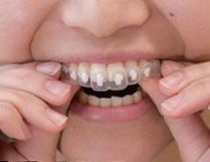 相模原市中央区横山エリア・のりデンタルクリニック・ホームブリーチ