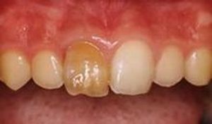 相模原市中央区横山エリア・のりデンタルクリニック・ウォーキングブリーチ