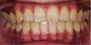 相模原市中央区横山エリア・のりデンタルクリニック・ガムピーリング